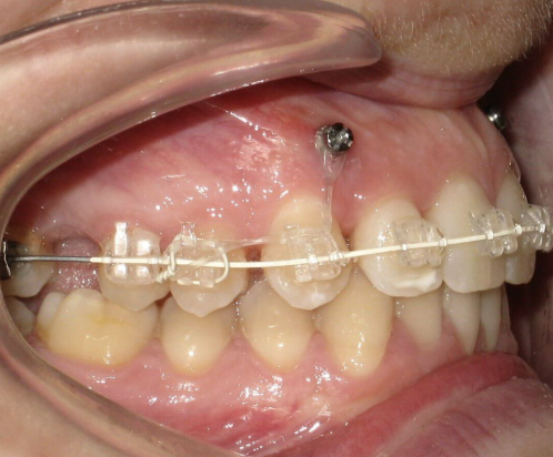 Microtornillo dental instalado - Dr. Aguilera Dental Coique