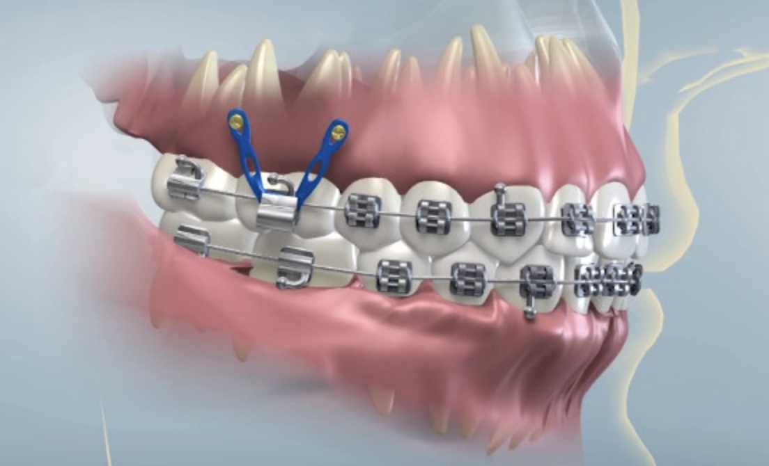 Microtornillo dental vista oclusal - Dental Coique Valdivia